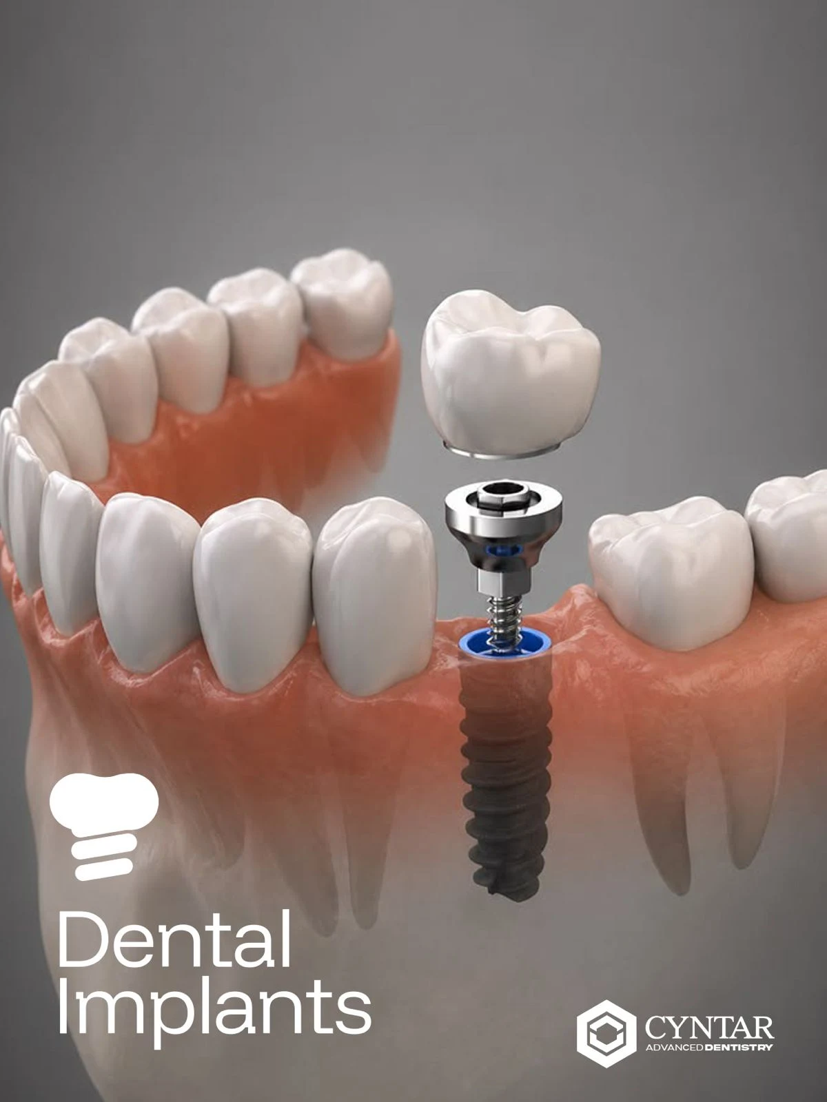 Illustration of a dental implant and crown