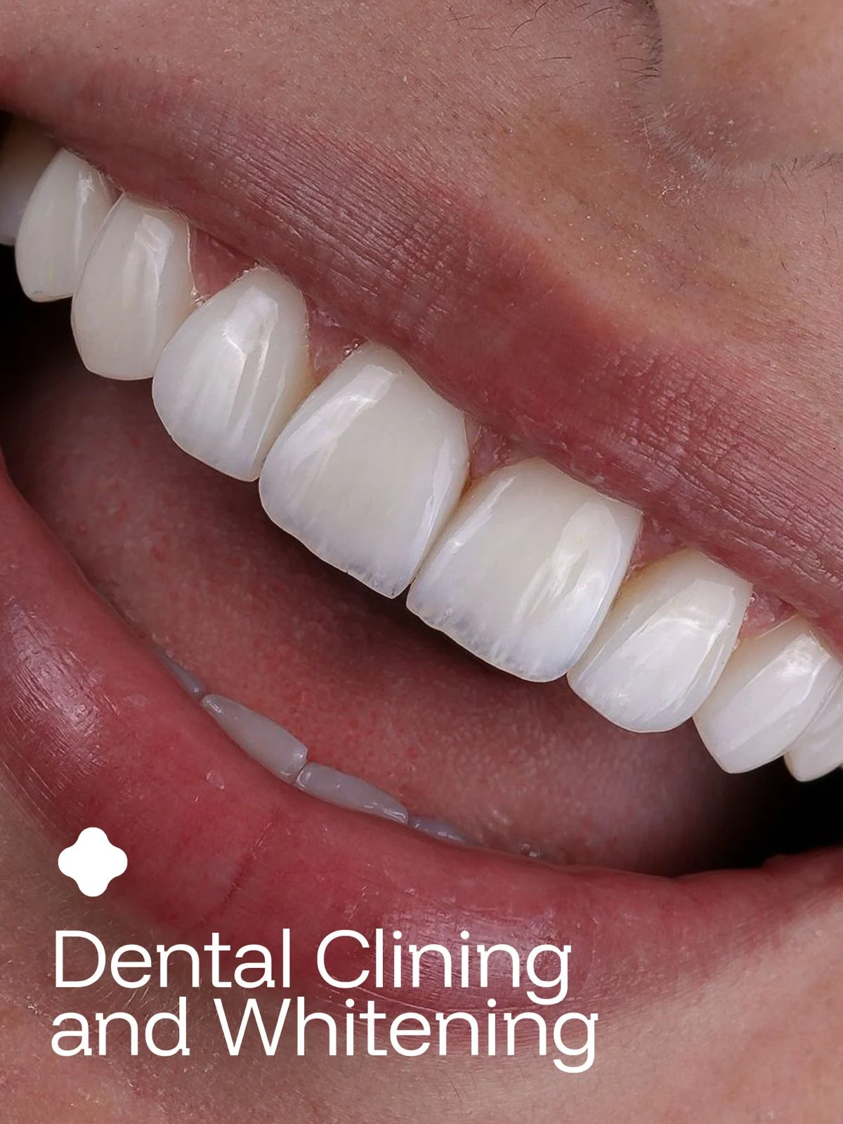 Close-up smile illustrating cleaning and whitening