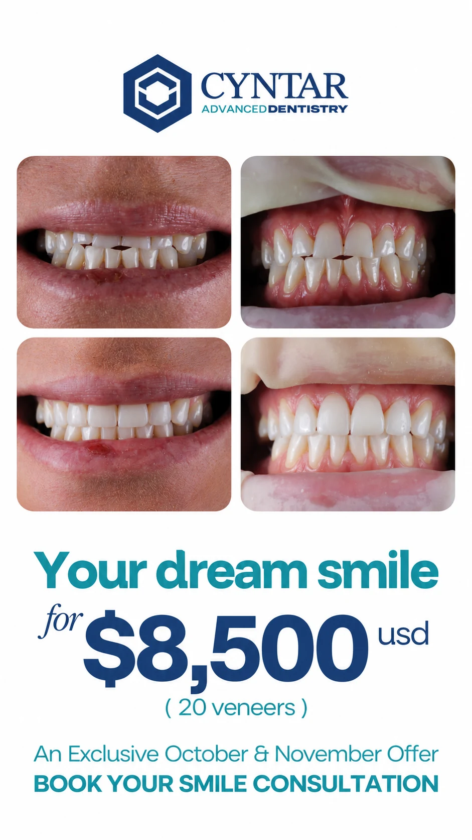 Supplied 20-veneer opening promotion with smile photographs